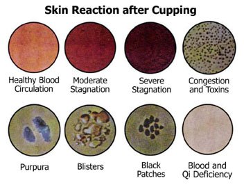 cupping reactions